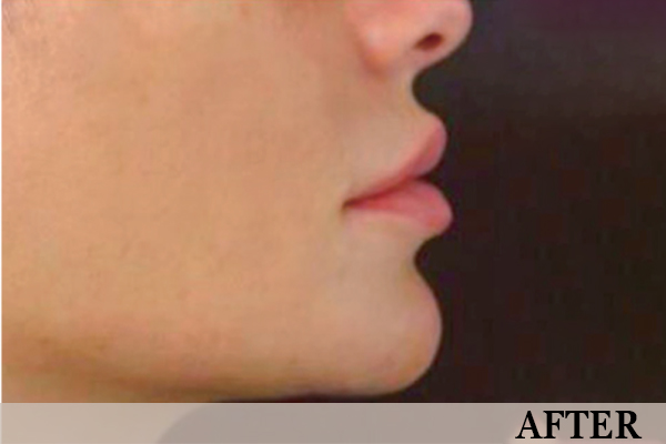 after-lips